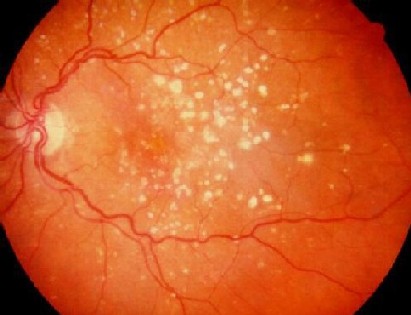 alt mce_tsrc=images/stories/macular-degeneration-dry.jpg