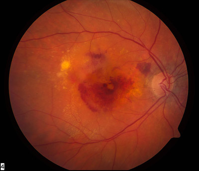 alt mce_tsrc=images/stories/wet_macular_fundus.jpg